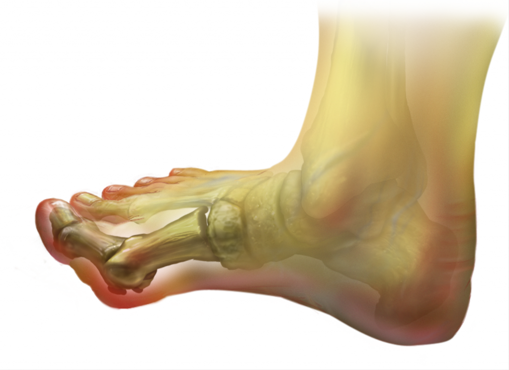 Bunions | Central Virginia Foot & Ankle Laser Center